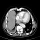 Small pneumoperitoneum, perforation of sigmoid colon, acute diverticulitis: CT - Computed tomography